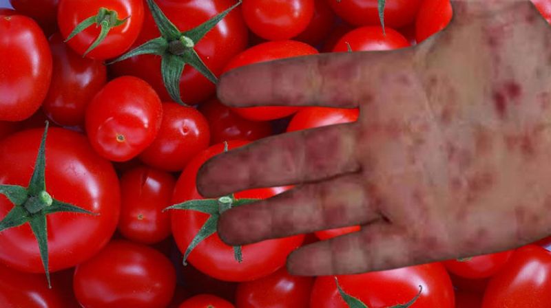 الطماطم مرض غامض يستهدف الأطفال ويثير القلق min