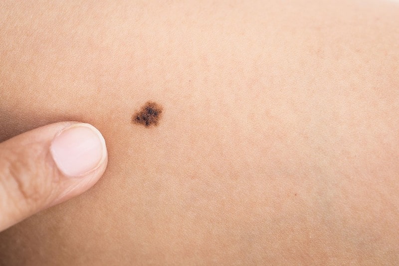 ما هي علامات تحول الشامات إلى سرطان الجلد min
