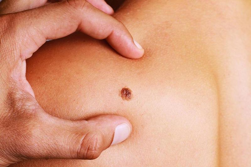 نظام غذائي يثبت قدرته على محاربة أخطر أنواع سرطان الجلد