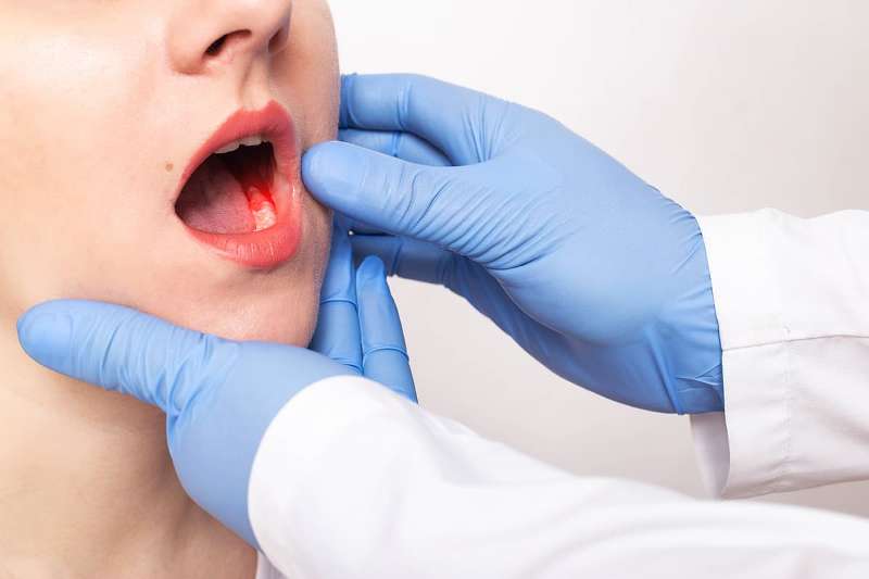 أعراض لسرطان الفم يجب أن يعرفها الجميع