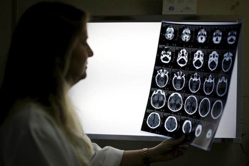 علاج يدمر أورام الدماغ الأكثر فتكا