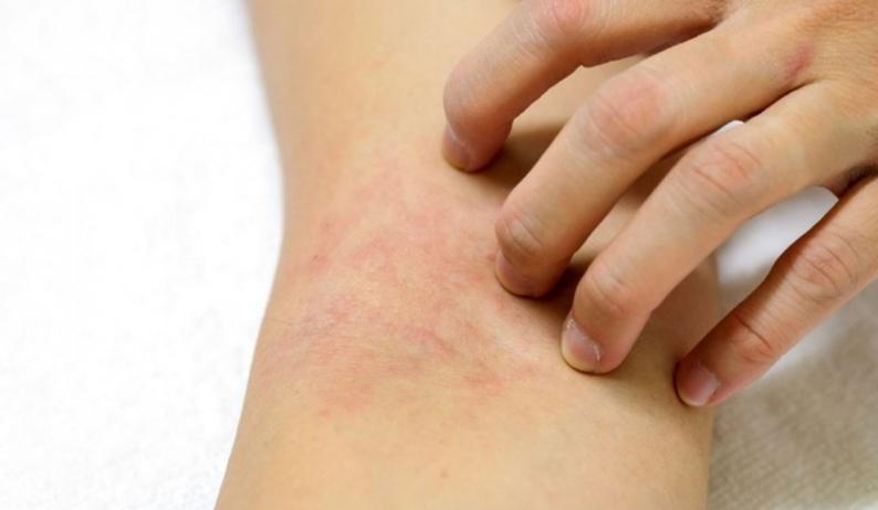 علامات على الجلد يمكن أن تشير إلى نقص أحد المغذيات الأساسية في الجسم