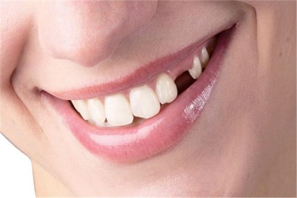 اكتشاف ارتباط بين فقدان الأسنان وزيادة خطر السمنة